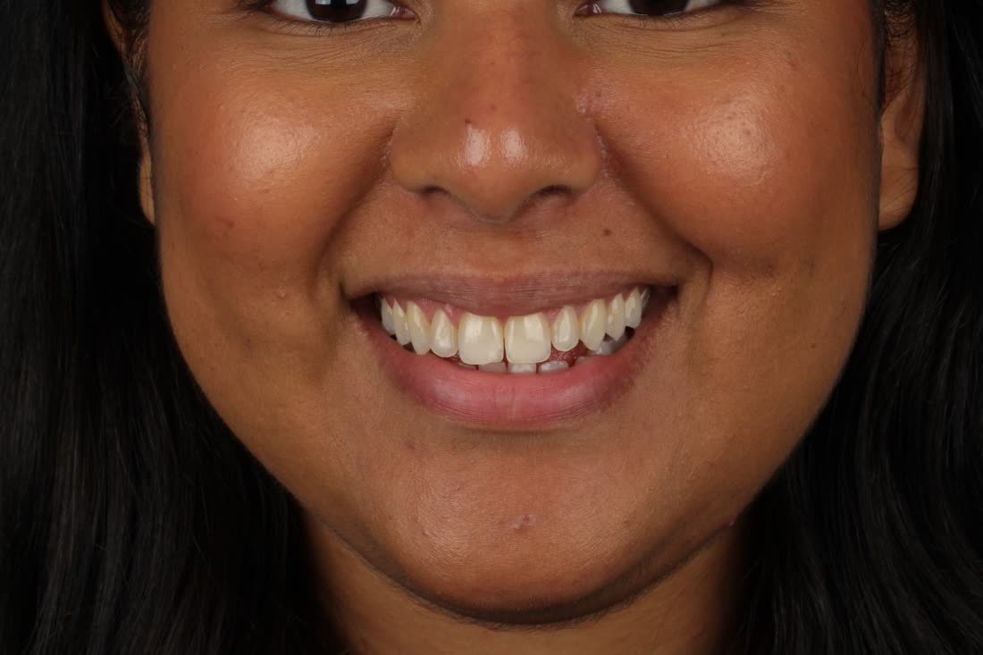 Antes, sorriso com espaços
